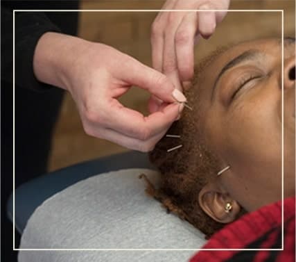 Home 28 a female patient receiving dry needling treatment in her head at Active Edge Columbus Ohio